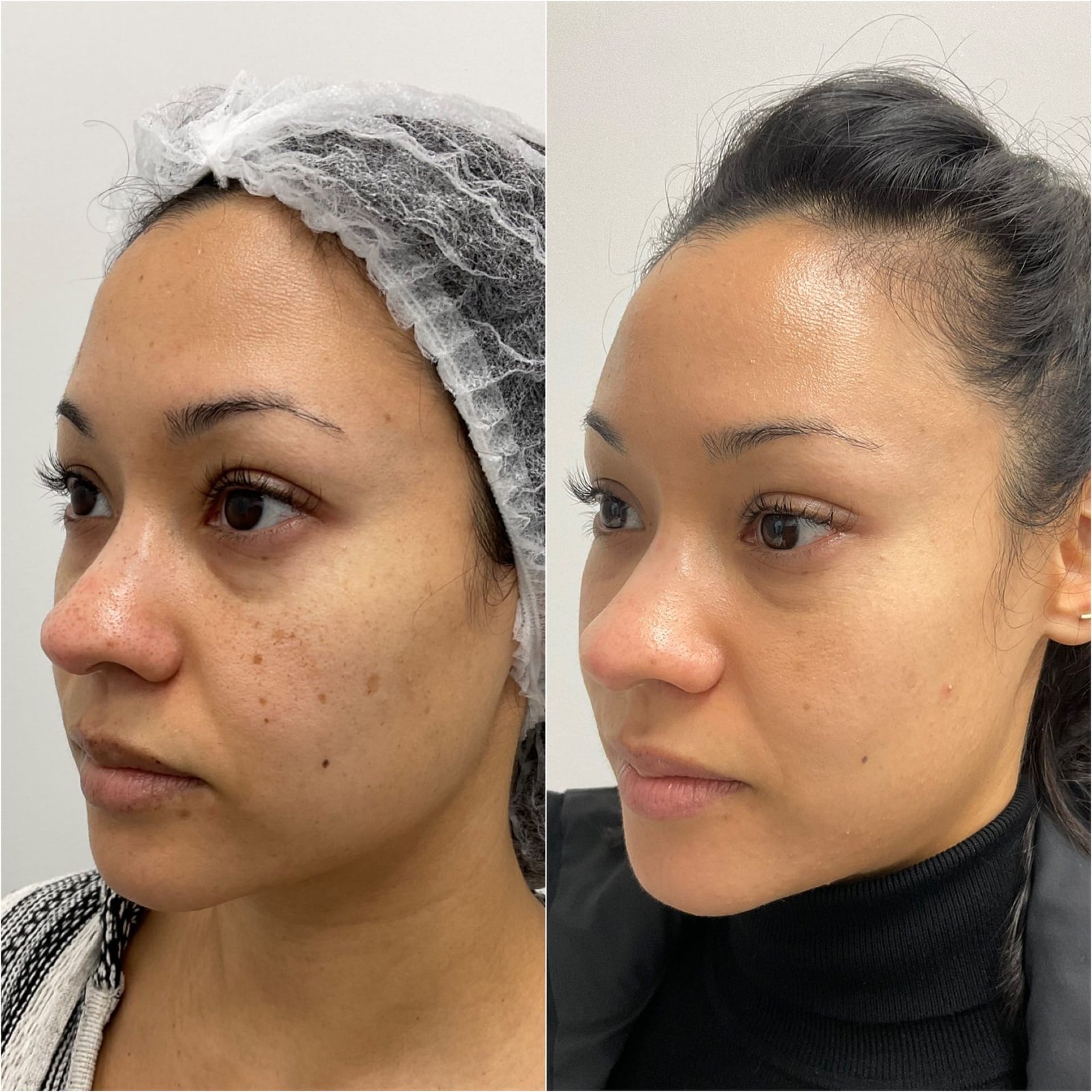 Side-by-side comparison showing the remarkable skin transformation two weeks after a combination BBL and HALO treatment by Nurse Jacklyn, highlighting improved tone, texture, and radiance.
