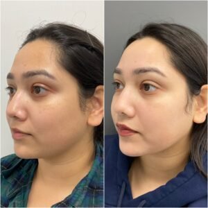 Side-by-side images showing the remarkable transformation achieved with BBL/Moxi/HALO treatment by Nurse Jacklyn. The 'before' photo on the left displays uneven skin tone, redness, and visible signs of sun damage. The 'after' photo on the right reveals a smoother, more radiant complexion with reduced redness, minimized pigmentation, and an overall rejuvenated appearance, highlighting the treatment's effectiveness in improving skin texture and tone.