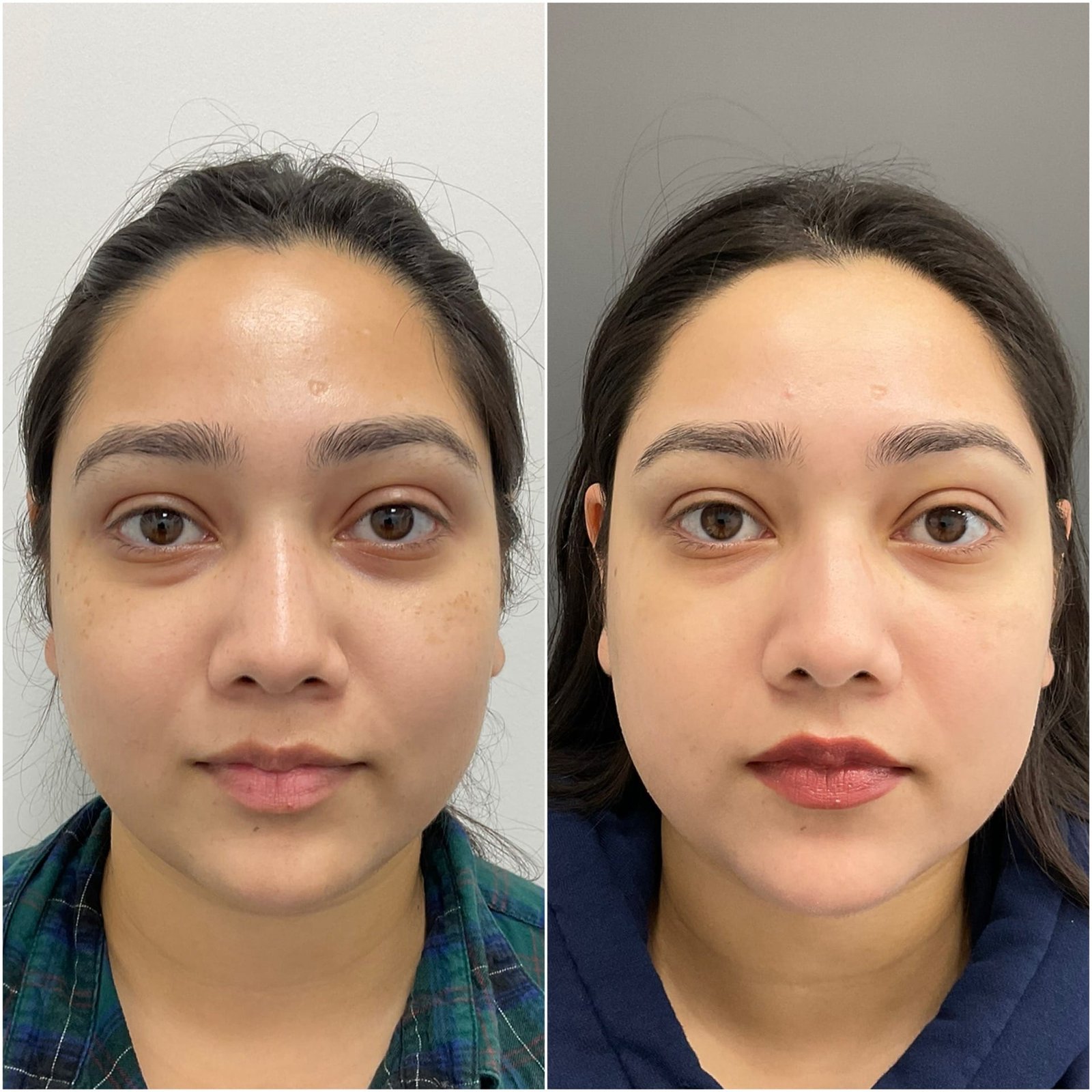 Side-by-side images showing the remarkable transformation achieved with BBL/Moxi/HALO treatment by Nurse Jacklyn. The 'before' photo on the left displays uneven skin tone, redness, and visible signs of sun damage. The 'after' photo on the right reveals a smoother, more radiant complexion with reduced redness, minimized pigmentation, and an overall rejuvenated appearance, highlighting the treatment's effectiveness in improving skin texture and tone.