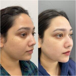 Side-by-side images showing the remarkable transformation achieved with BBL/Moxi/HALO treatment by Nurse Jacklyn. The 'before' photo on the left displays uneven skin tone, redness, and visible signs of sun damage. The 'after' photo on the right reveals a smoother, more radiant complexion with reduced redness, minimized pigmentation, and an overall rejuvenated appearance, highlighting the treatment's effectiveness in improving skin texture and tone.