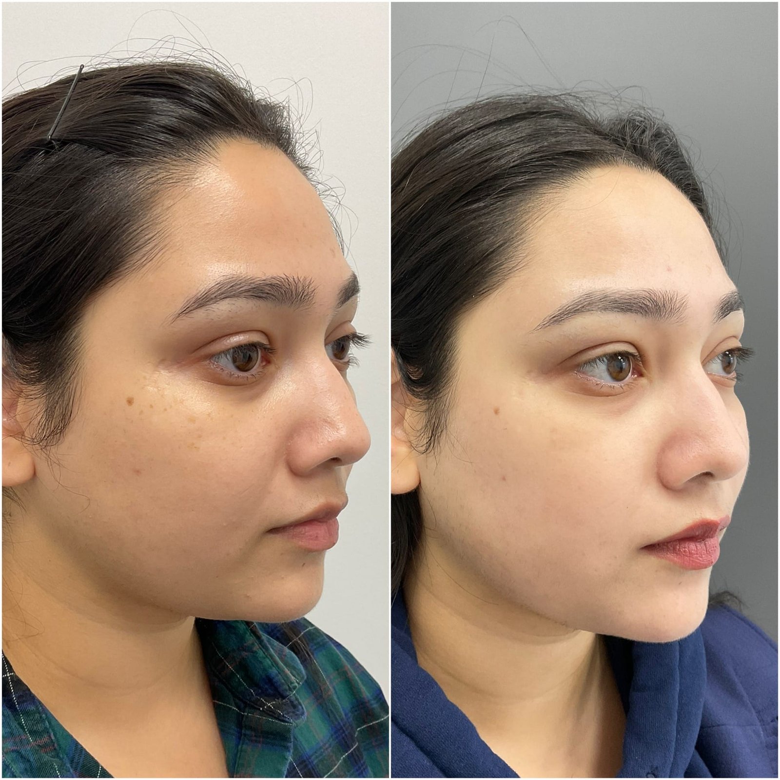 Side-by-side images showing the remarkable transformation achieved with BBL/Moxi/HALO treatment by Nurse Jacklyn. The 'before' photo on the left displays uneven skin tone, redness, and visible signs of sun damage. The 'after' photo on the right reveals a smoother, more radiant complexion with reduced redness, minimized pigmentation, and an overall rejuvenated appearance, highlighting the treatment's effectiveness in improving skin texture and tone.