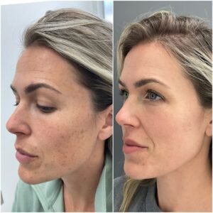 Sciton BBL and Halo Combo treatment by Nurse Jacklyn to treat Sun Damage, Freckles, Brown Spots, Age Spots, PIH, hyperpigmentation and pigmentation