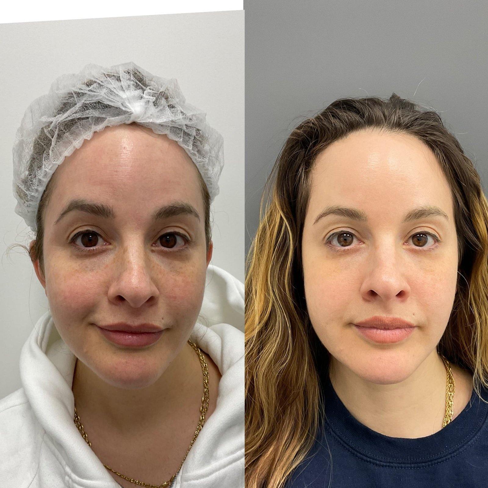 Side-by-side images showing the remarkable transformation achieved with BBL//HALO treatment by Nurse Jacklyn. The 'before' photo on the left displays uneven skin tone, redness, and visible signs of sun damage. The 'after' photo on the right reveals a smoother, more radiant complexion with reduced redness, minimized pigmentation, and an overall rejuvenated appearance, highlighting the treatment's effectiveness in improving skin texture and tone.