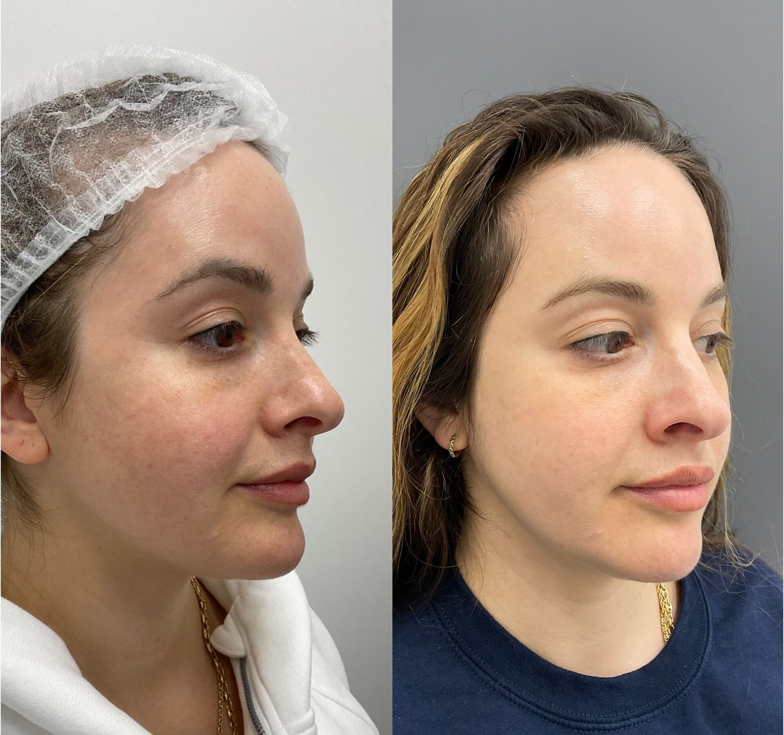 Side-by-side images showing the remarkable transformation achieved with BBL//HALO treatment by Nurse Jacklyn. The 'before' photo on the left displays uneven skin tone, redness, and visible signs of sun damage. The 'after' photo on the right reveals a smoother, more radiant complexion with reduced redness, minimized pigmentation, and an overall rejuvenated appearance, highlighting the treatment's effectiveness in improving skin texture and tone.