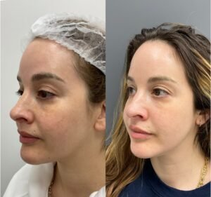 Side-by-side images showing the remarkable transformation achieved with BBL//HALO treatment by Nurse Jacklyn. The 'before' photo on the left displays uneven skin tone, redness, and visible signs of sun damage. The 'after' photo on the right reveals a smoother, more radiant complexion with reduced redness, minimized pigmentation, and an overall rejuvenated appearance, highlighting the treatment's effectiveness in improving skin texture and tone.