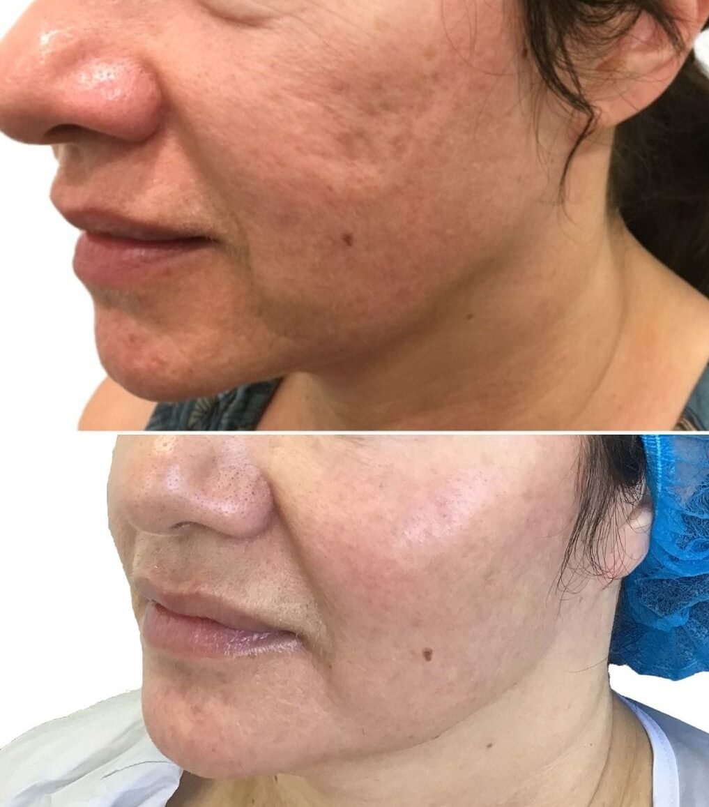 Acne Scars