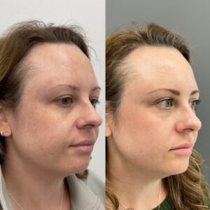BBL and MOXI combination treatment for skin rejuvenation and sun damage, performed by Nurse Jacklyn