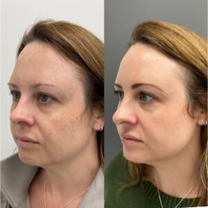 Side-by-side images showing the remarkable transformation achieved with BBL and MOXI combination treatment for skin rejuvenation and sun damage, performed by Nurse Jacklyn