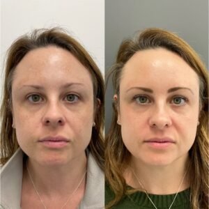 Side-by-side images showing the remarkable transformation achieved with BBL and MOXI combination treatment for skin rejuvenation and sun damage, performed by Nurse Jacklyn