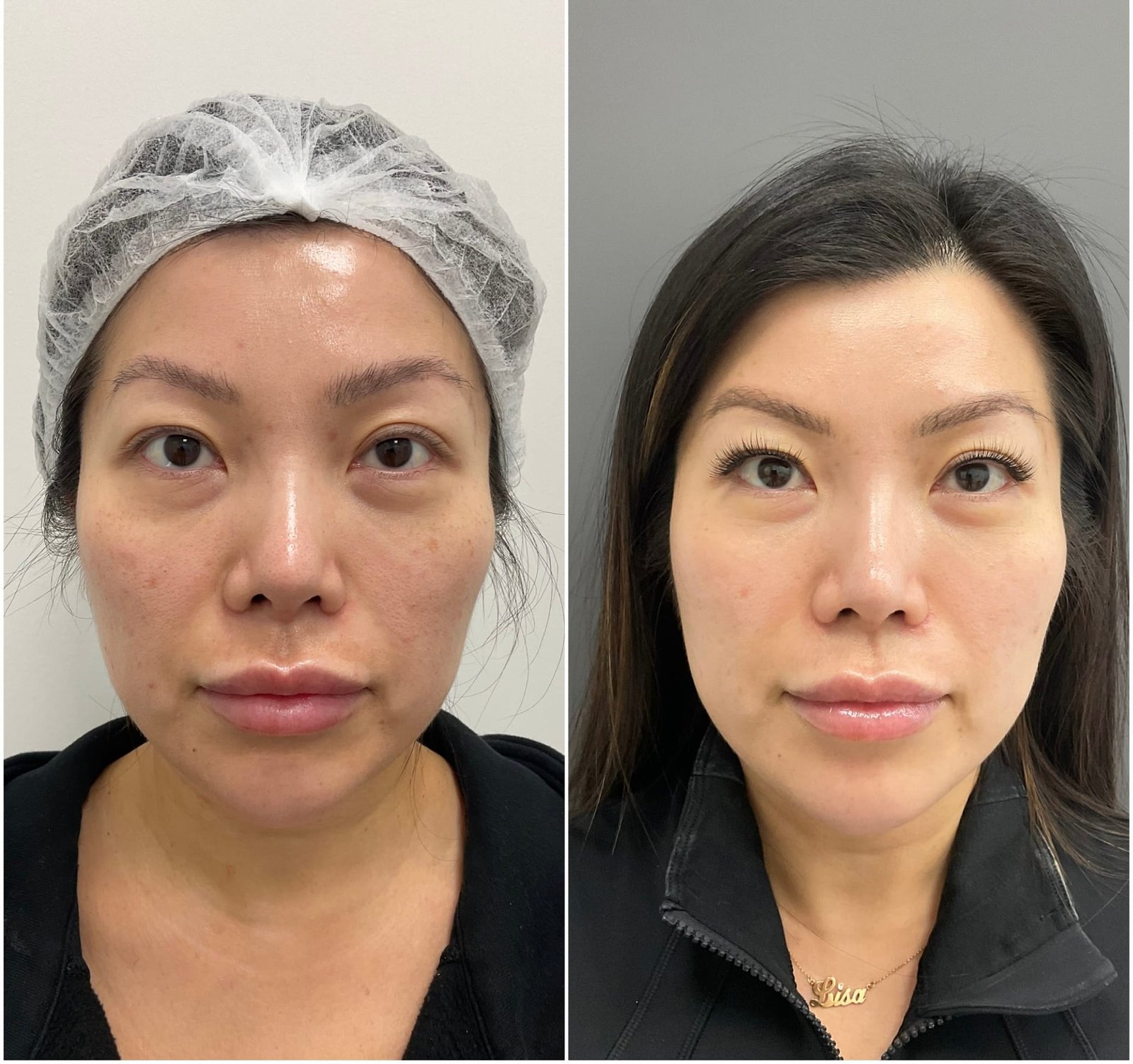 BBL and HALO treatment for brown spots, skin texture and sun damage, performed by Nurse Jacklyn