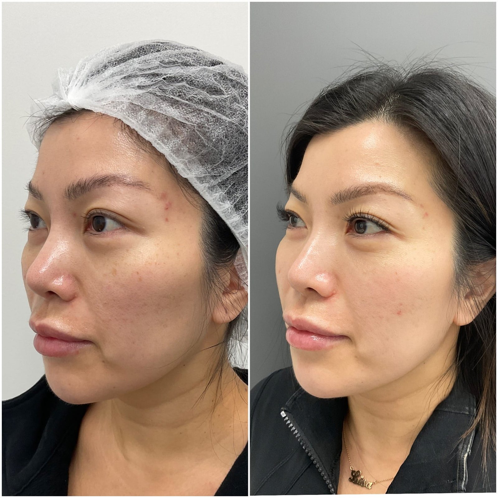 BBL and HALO treatment for brown spots, skin texture and sun damage, performed by Nurse Jacklyn