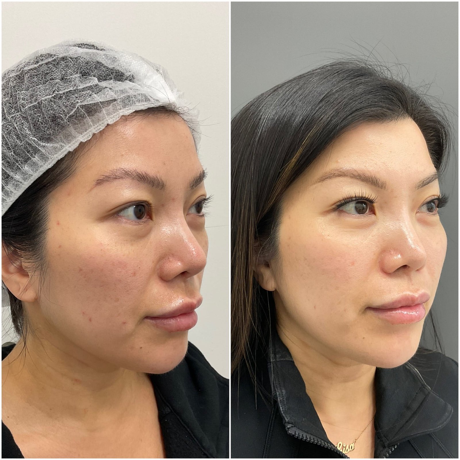 BBL and HALO treatment for brown spots, skin texture and sun damage, performed by Nurse Jacklyn