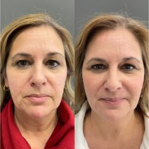 Side-by-side images showing the results after Bellafill and ProFractional laser treatments for acne scars—note the smoother skin texture, reduced scar depth, and overall improvement in skin tone and clarity. This combination treatment helps restore confidence by delivering long-lasting collagen stimulation and visible skin rejuvenation, performed by Nurse Jacklyn.