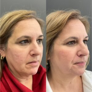 Side-by-side images showing the results after Bellafill and ProFractional laser treatments for acne scars—note the smoother skin texture, reduced scar depth, and overall improvement in skin tone and clarity. This combination treatment helps restore confidence by delivering long-lasting collagen stimulation and visible skin rejuvenation, performed by Nurse Jacklyn.