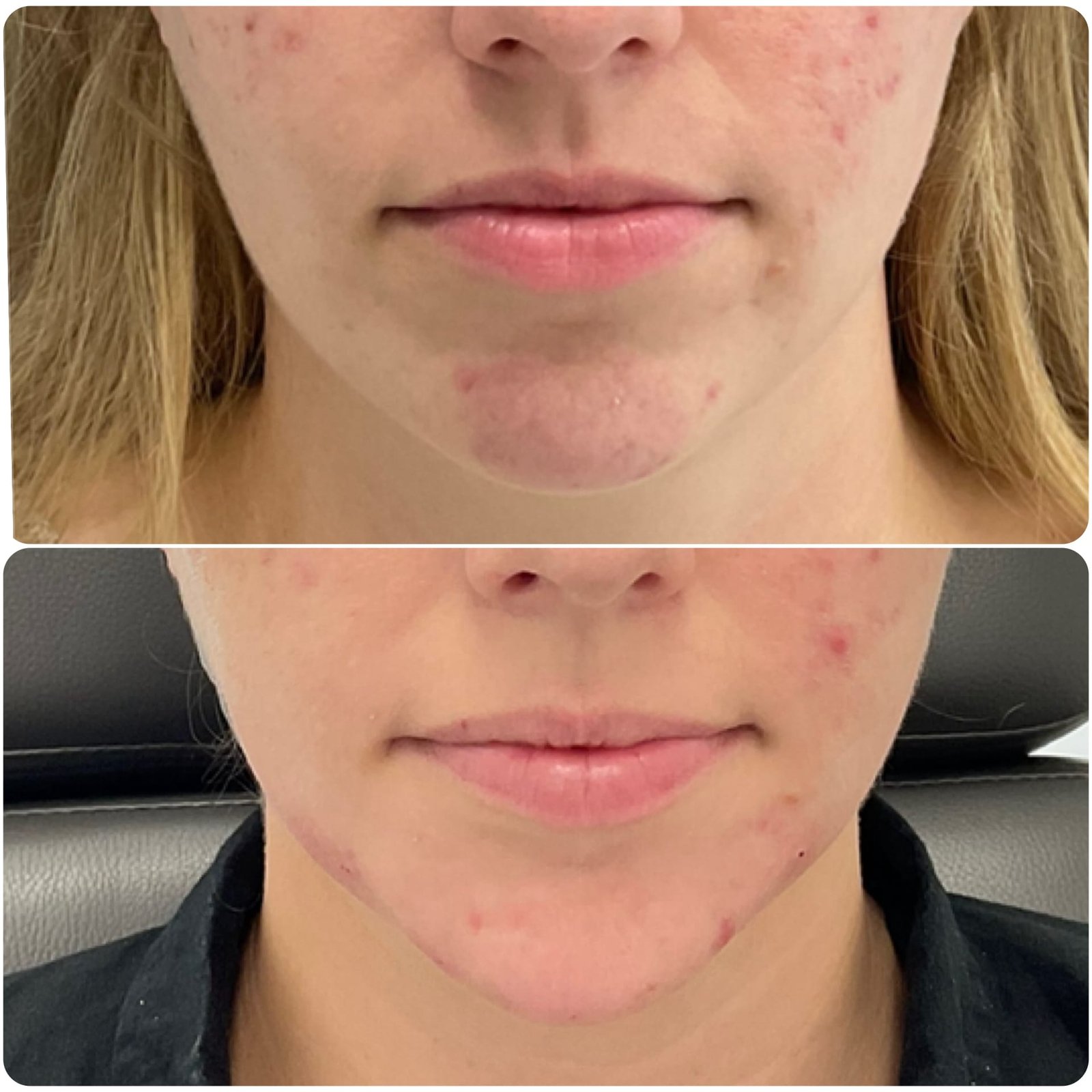 Side-by-side images showing the results after 2 syringes of filler in the chin area—notice the overall aesthetic improvement, including increased vertical height of the chin, enhanced anterior projection, softened chin shadows, and more pleasant positioning of the mouth corners. Overall, the treatment delivers improved facial contour and balance performed by Nurse Jacklyn
