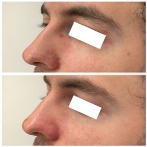 Side-by-side images showing the improvement after Clear V laser treatment for Nasal vessels , spider angioma and cherry angioma performed by Nurse Jacklyn.