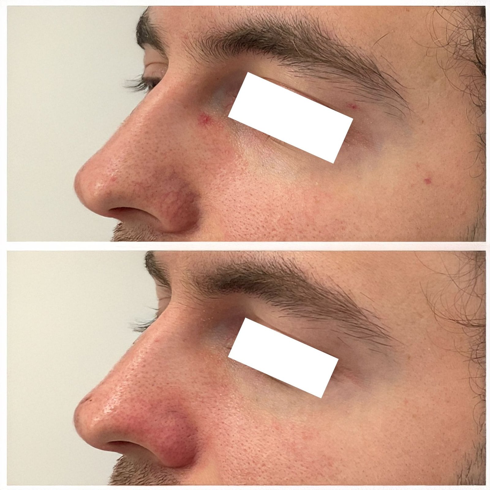 Side-by-side images showing the improvement after Clear V laser treatment for Nasal vessels , spider angioma and cherry angioma performed by Nurse Jacklyn.
