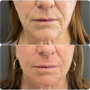 Side-by-side images showing the results of Contour TRL erbium fully ablative resurfacing treatment for peri-oral lines, performed by Nurse Jacklyn