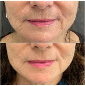 Side-by-side images showing the improvement after Erbium Fully Ablative Resurfacing (Contour TRL) for upper lip lines—performed by Nurse Jacklyn.