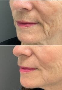 Side-by-side images showing the improvement after Erbium Fully Ablative Resurfacing (Contour TRL) for upper lip lines—performed by Nurse Jacklyn.