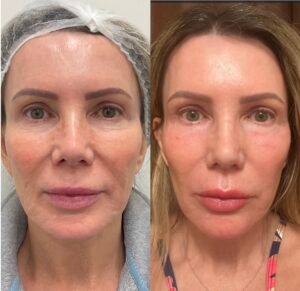 Side-by-side images showing the results of Erbium Fully Ablative Resurfacing Laser treatment, including full face resurfacing and under-eye rejuvenation, non-surgical blepharoplasty, performed by Nurse Jacklyn