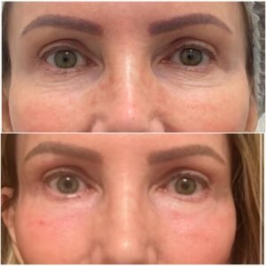 Side-by-side images showing the results of Erbium Fully Ablative Resurfacing Laser treatment, including full face resurfacing and under-eye rejuvenation, non-surgical blepharoplasty, performed by Nurse Jacklyn