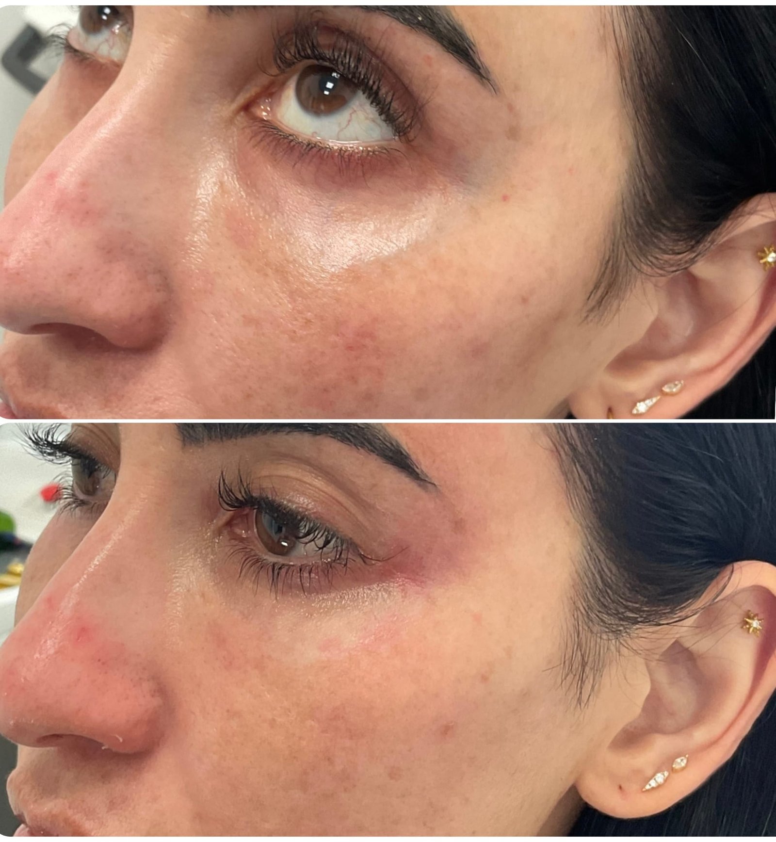 Side-by-side images showing the results of Clear V treatment for periorbital vein removal, performed by Nurse Jacklyn.