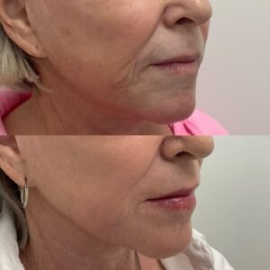 Side-by-side images showing the improvement after Erbium Fully Ablative Resurfacing (Contour TRL) for upper lip lines, cheeks, and face resurfacing —performed by Nurse Jacklyn.