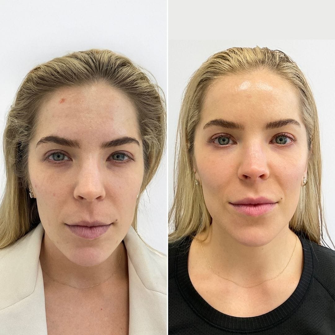 Filler for chin and jawline by Nurse Jacklyn before and after