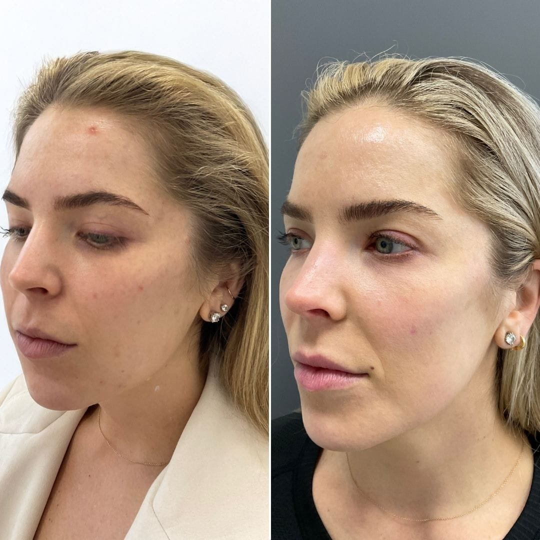 Filler for chin and jawline by Nurse Jacklyn before and after