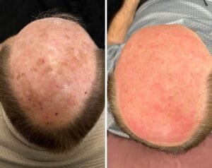 Before and after ablative laser resurfacing treatment for sun damage with Sciton's Contour TRL as performed by Nurse Jacklyn