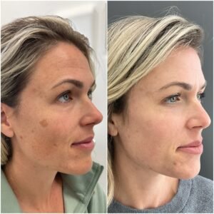 Sciton BBL and Halo Combo treatment by Nurse Jacklyn to treat Sun Damage, Freckles, Brown Spots, Age Spots, PIH, hyperpigmentation and pigmentation