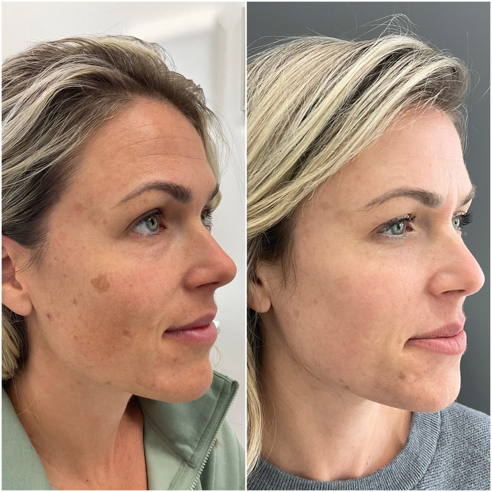 Sciton BBL and Halo Combo treatment by Nurse Jacklyn to treat Sun Damage, Freckles, Brown Spots, Age Spots, PIH, hyperpigmentation and pigmentation