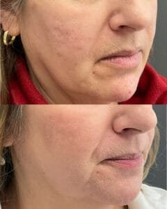Side-by-side images showing the results after Bellafill and ProFractional laser treatments for acne scars—note the smoother skin texture, reduced scar depth, and overall improvement in skin tone and clarity. This combination treatment helps restore confidence by delivering long-lasting collagen stimulation and visible skin rejuvenation, performed by Nurse Jacklyn.