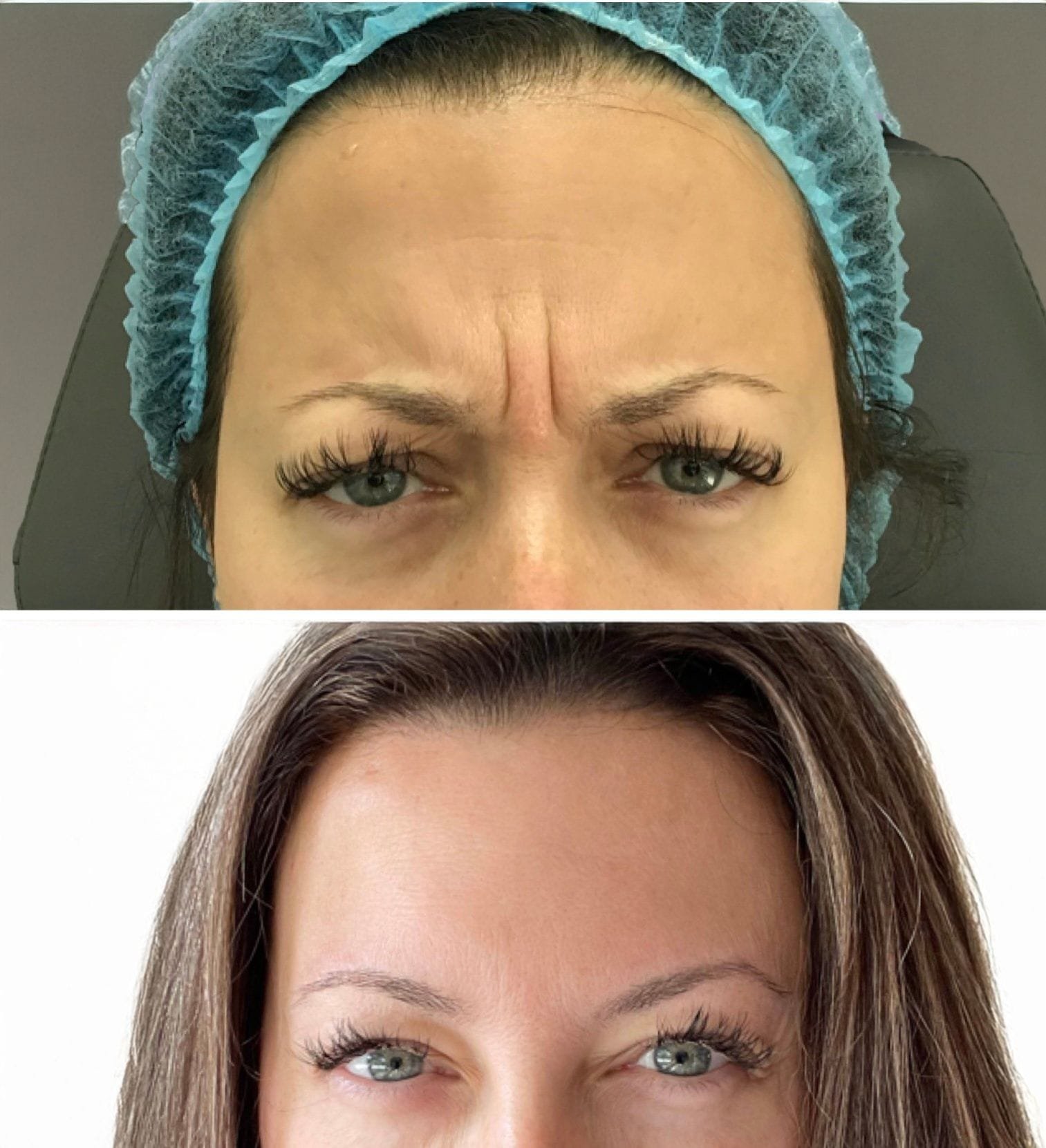 Botox-frownliness (1)