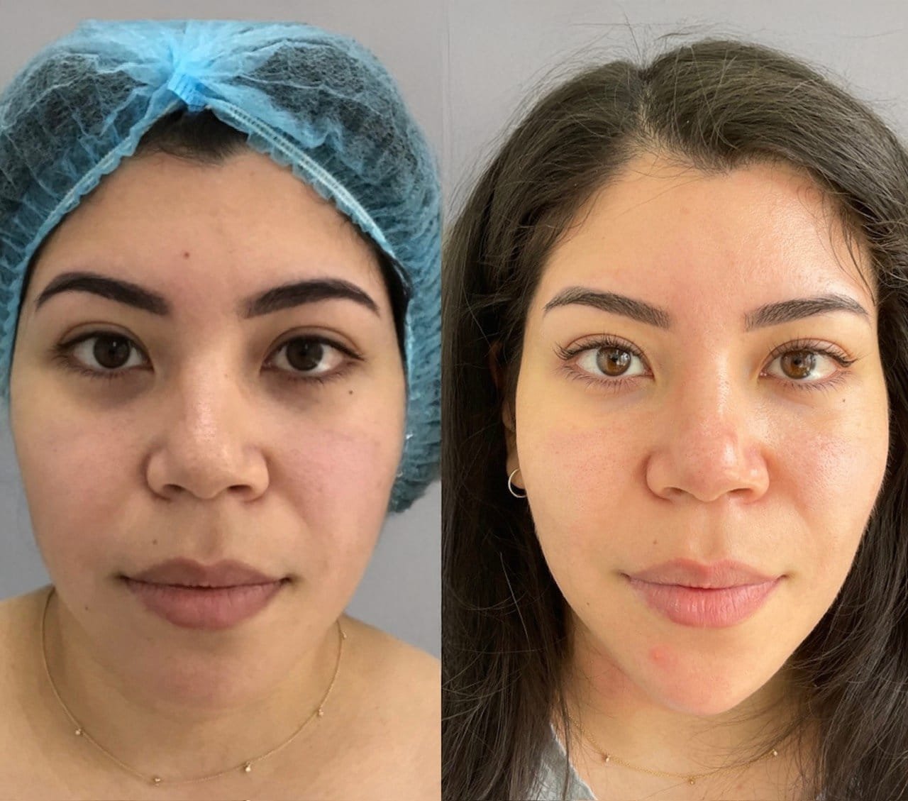 Befrore and after of Cheek Filler, Chin Filler and Tear Trough Filler by Nurse Jacklyn