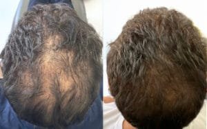 This patient of Nurse Jacklyn's received three sessions of exosomes combined with PRP for hair rejuvenation and restoration.