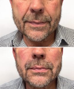 Silhouette Instalift thread lift before and after