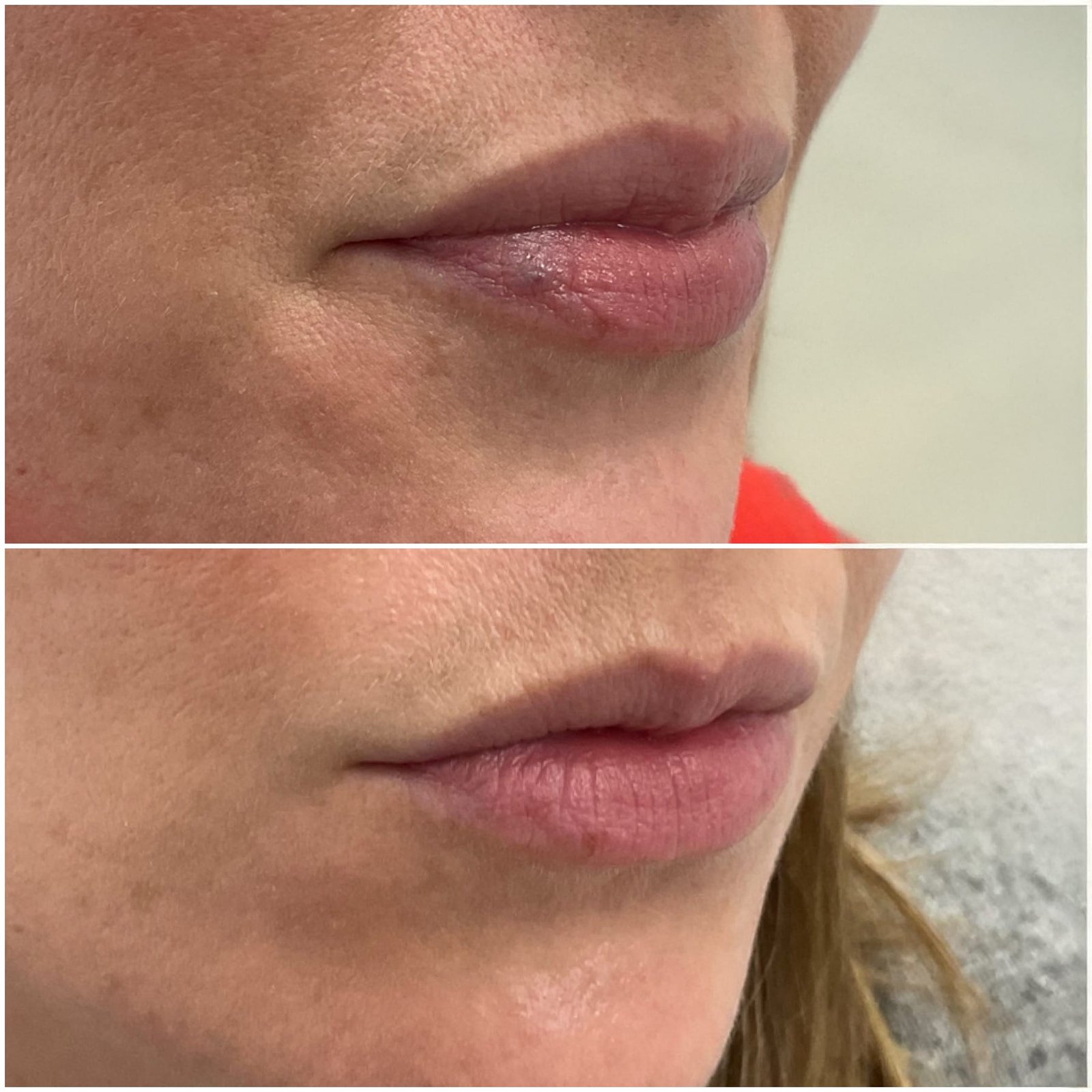 Venous lake before and after results following treatment with the ClearV by Sciton