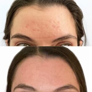 Nurse Jacklyn client with Acne Scars on her forehead before and after treatment