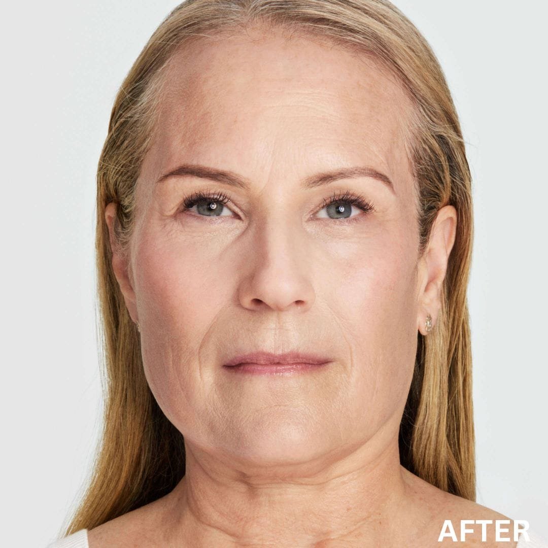 Ultherapy After