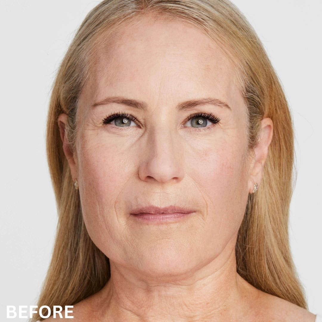 Ultherapy Before