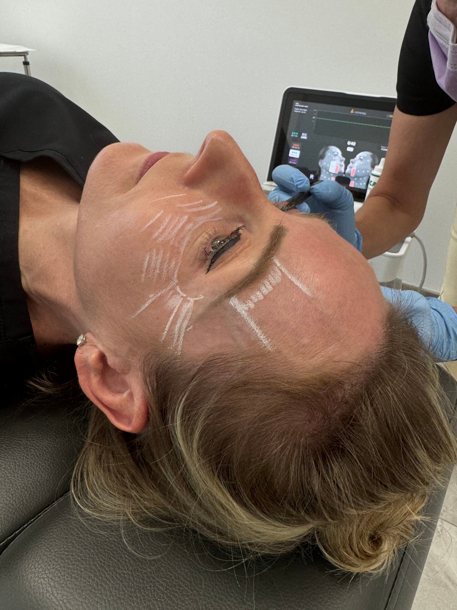 Patient getting ready for Ultherapy treatment