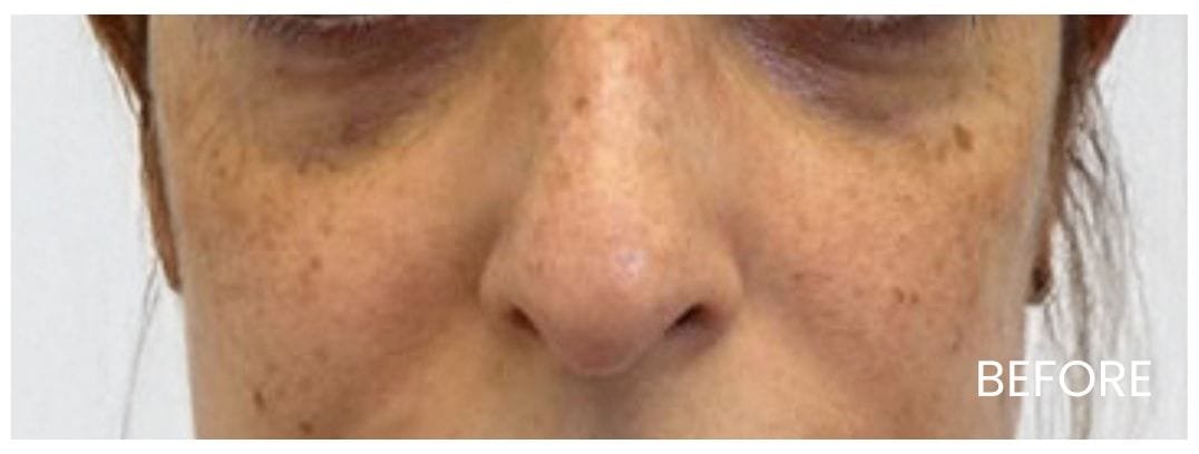 Under EYE PRF Before Image