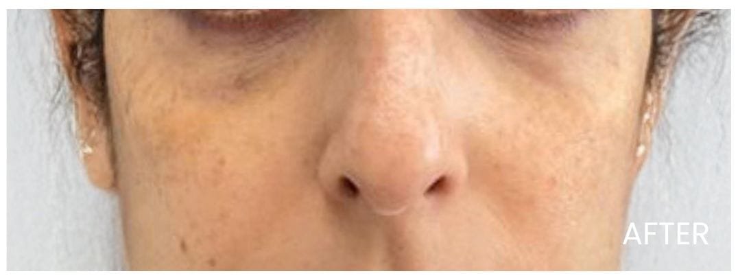 Under EYE PRF After Image