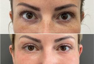 Under eye Laser resurfacing before and after