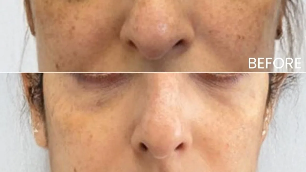 Before and After of under-eye rejuventation with PRF / PRP by Nurse Jacklyn