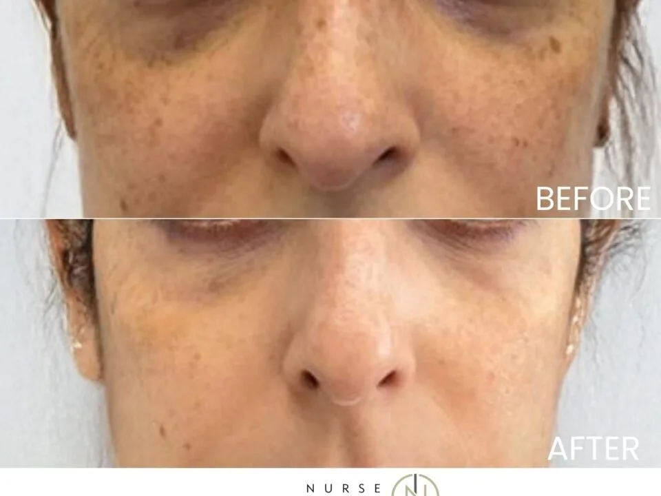 Before and After of under-eye rejuventation with PRF / PRP by Nurse Jacklyn
