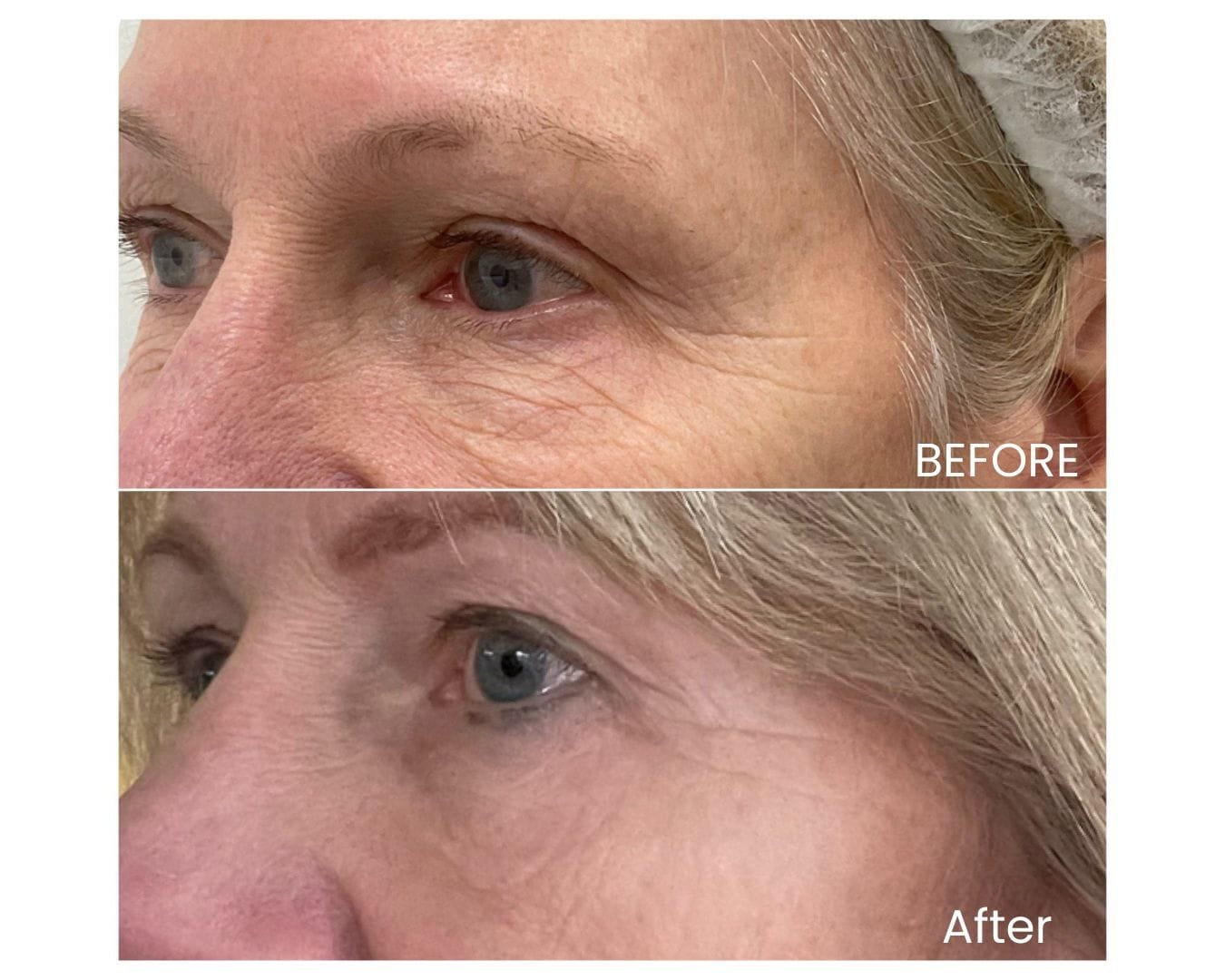 1ProFractional Laser resurfacing (Before-and-after)