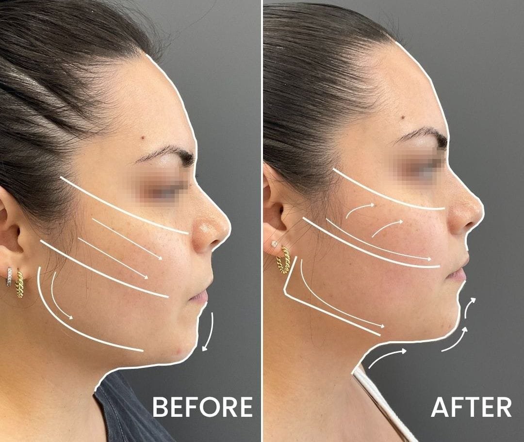 Fillers Before and After Newsletter